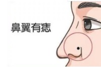 鼻子有痣的意思 如果鼻子准头长痣,说明有这种痣特征的人